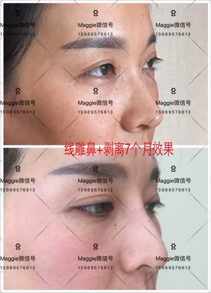 什么是剥离微雕|皮下剥离微雕是什么