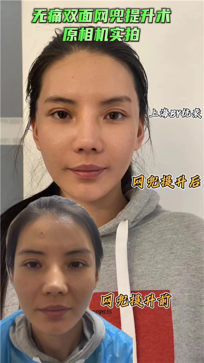 无痛双面网兜提升术