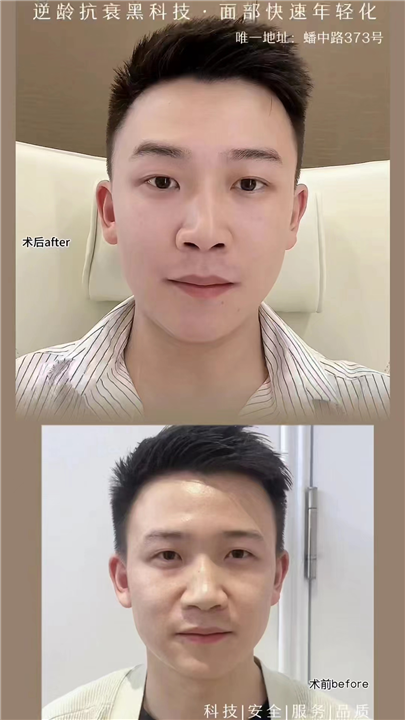 逆龄抗衰黑科技，双面网兜提升术