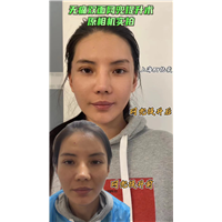 无痛双面网兜提升术