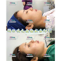 上海肋骨隆鼻整形哪家好|上海网红打造整形