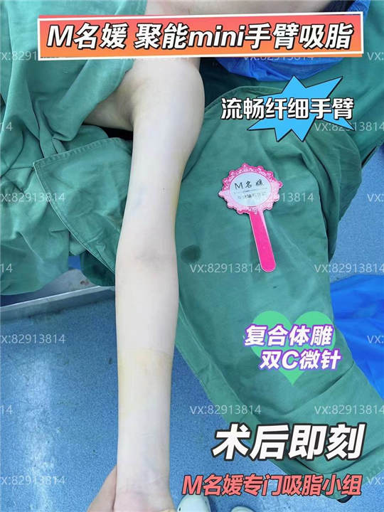 郑州吸脂哪家好