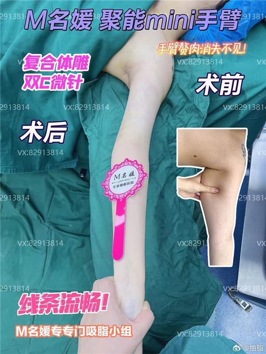 郑州无痛吸脂