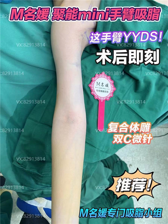 郑州吸脂哪家好