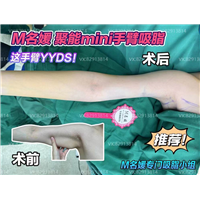 郑州吸脂哪家好