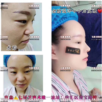 脸部自体脂肪填充价格 