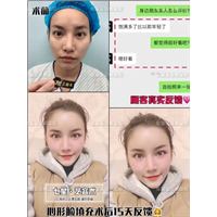 七星脂肪心形脸填充 