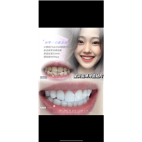 全瓷贴面美牙