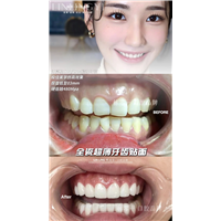 做牙齿贴面大概多少钱