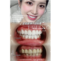 牙齿贴面