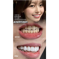瓷贴面能用一辈子吗