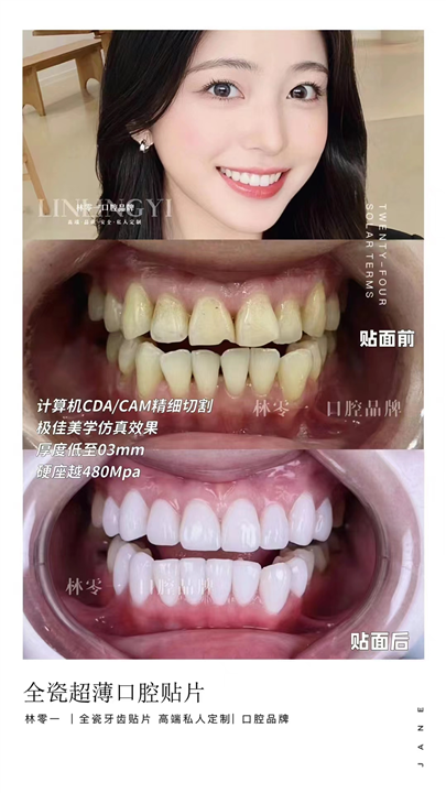 牙齿矫正，是不是超级疼疼疼？