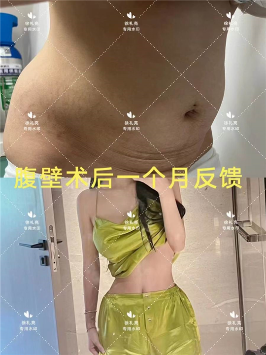 杭州腹壁成型术