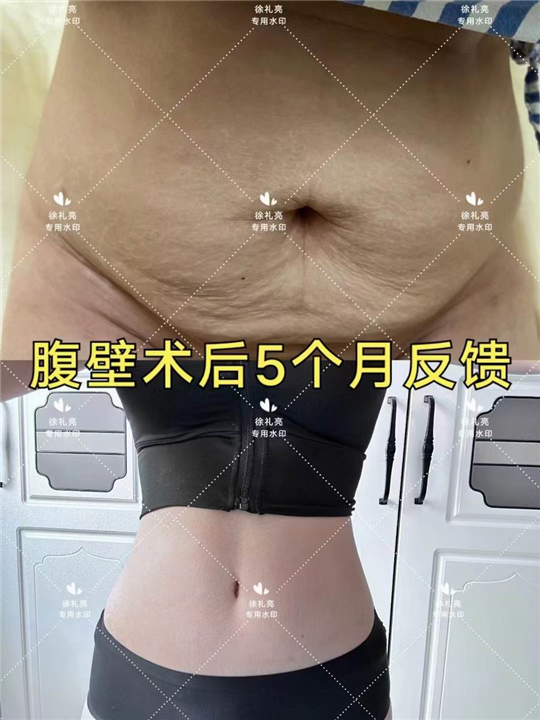 徐礼亮腹壁整形