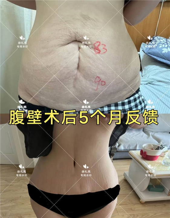 徐礼亮腹壁整形