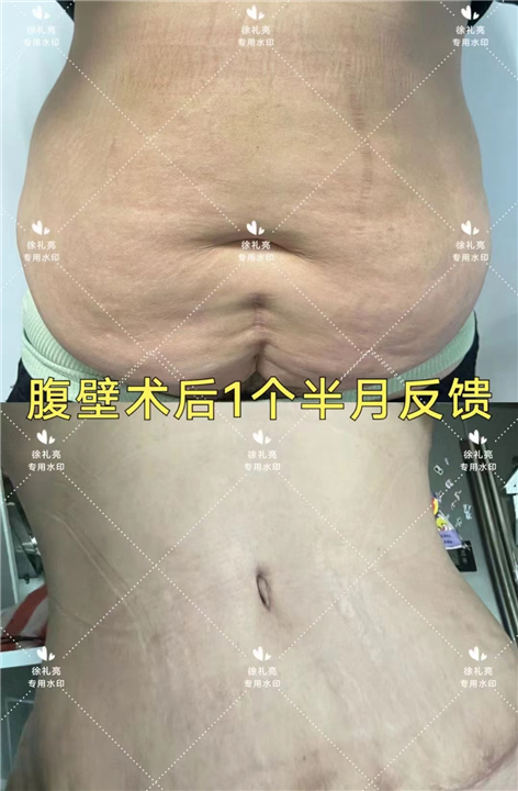 徐礼亮医生腹壁成型如何