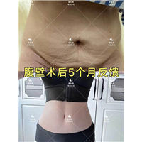 徐礼亮腹壁整形