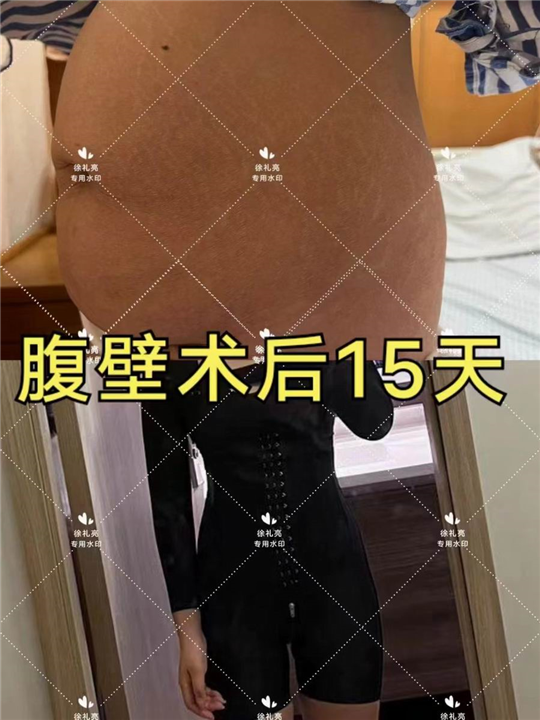 杭州徐礼亮医生