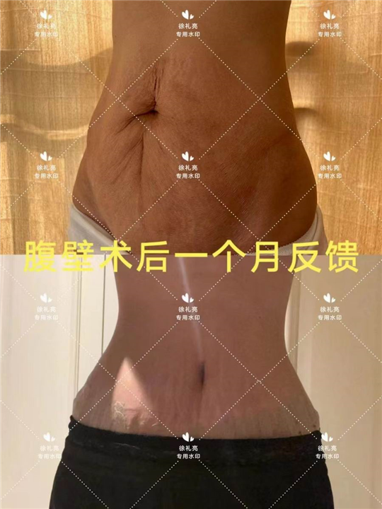 徐礼亮腹壁整形