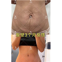 徐礼亮腹壁整形