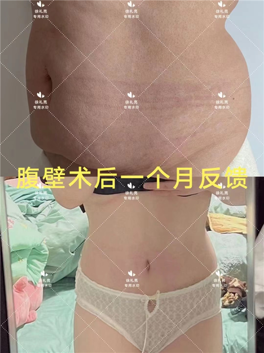 徐礼亮医生腹壁成型如何