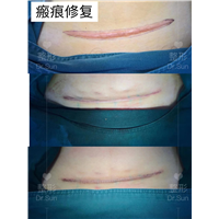 大连疤痕修复医生