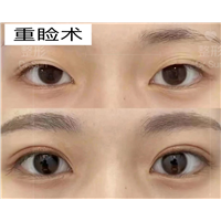 大连做双眼皮医生