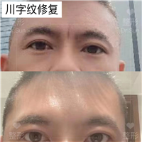 大连川字纹修复医生