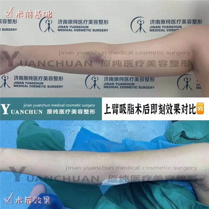 济南抽脂整形哪家好