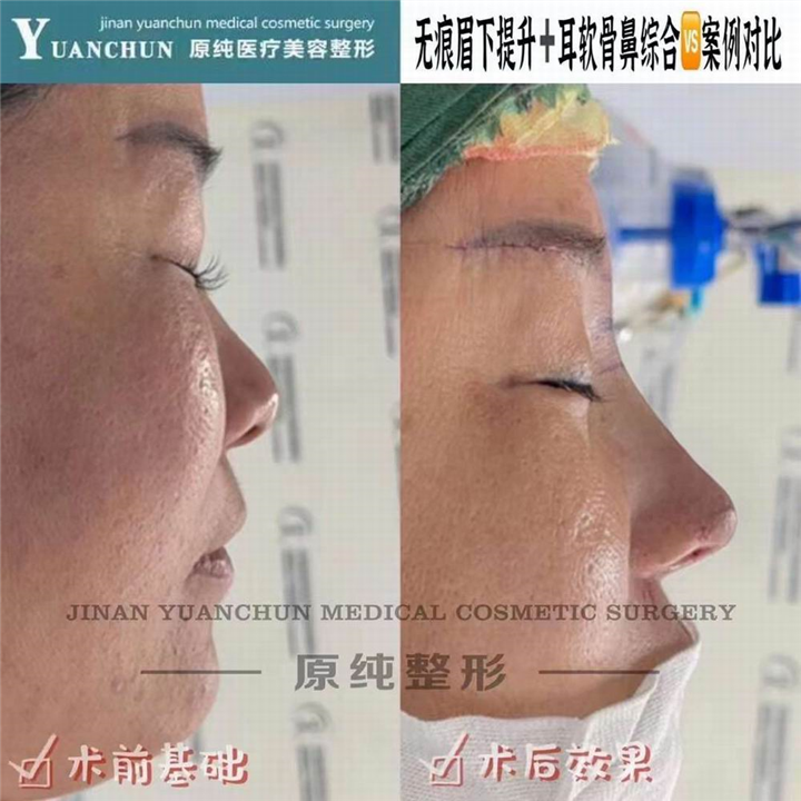 济南鼻综合整形