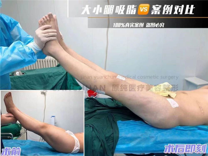 济南抽脂整形哪家好