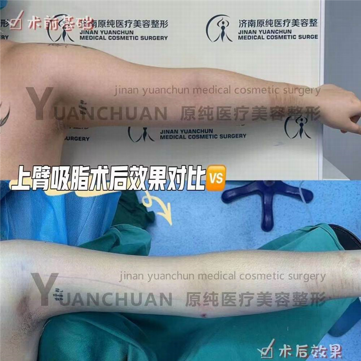 济南抽脂整形哪家好