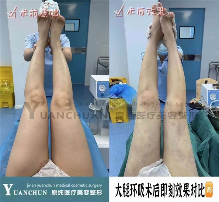 济南抽脂整形哪家好