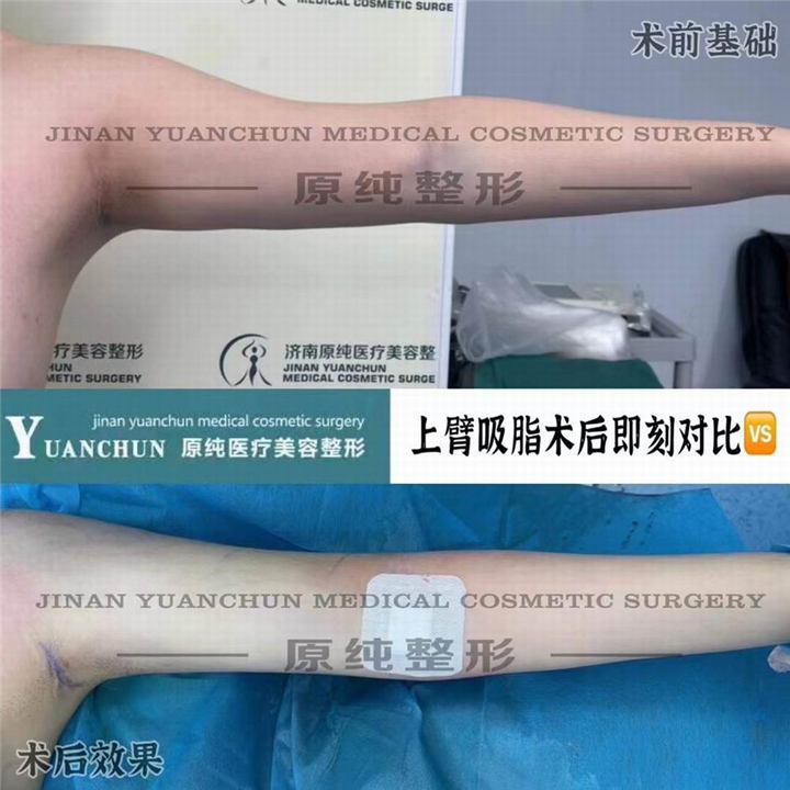 济南抽脂整形哪家好