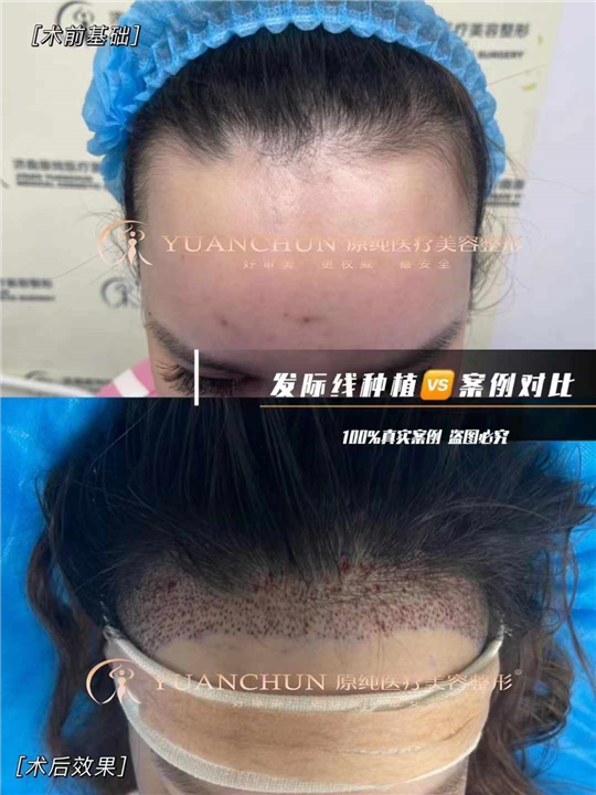 济南发际线种植多少钱