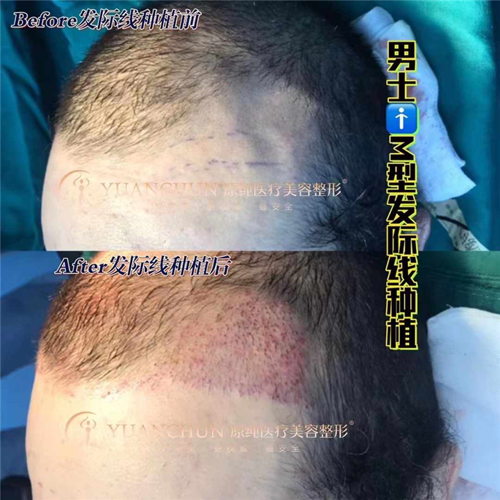 男士M型发际线种植