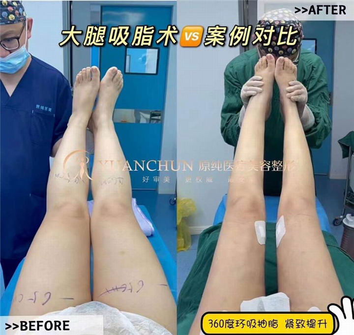 济南抽脂整形哪家好
