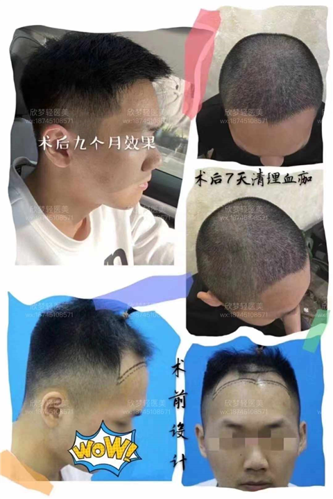 济南植发哪家好