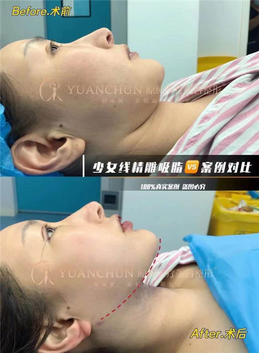 济南抽脂整形哪家好