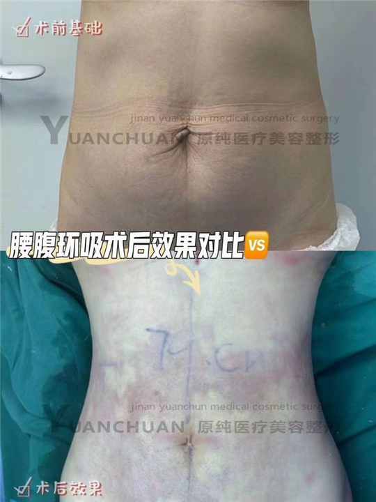 济南抽脂整形哪家好