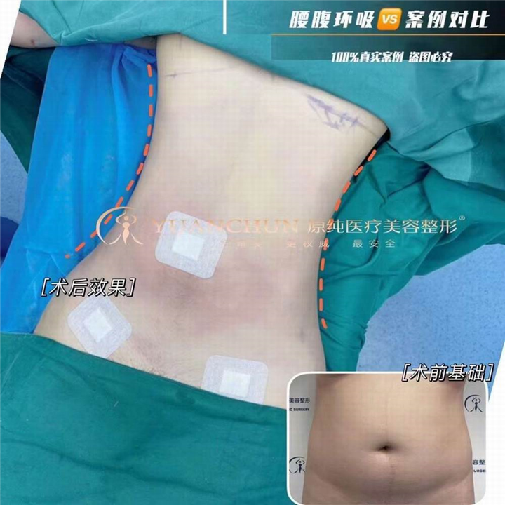 济南抽脂整形哪家好