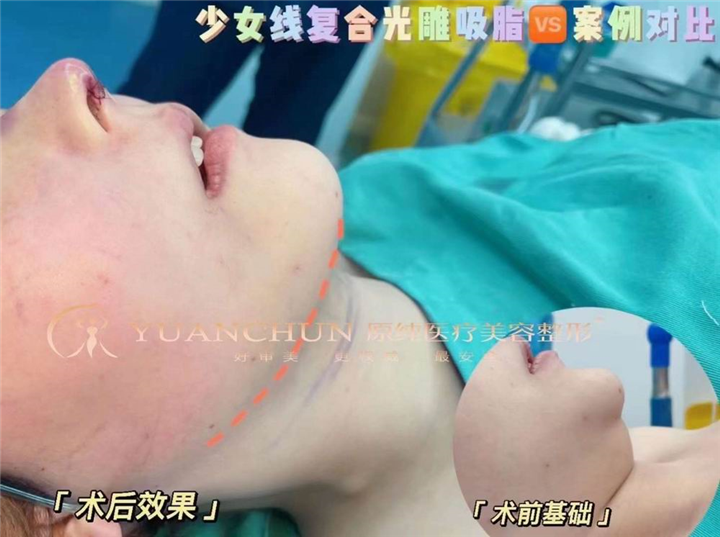 济南抽脂整形哪家好