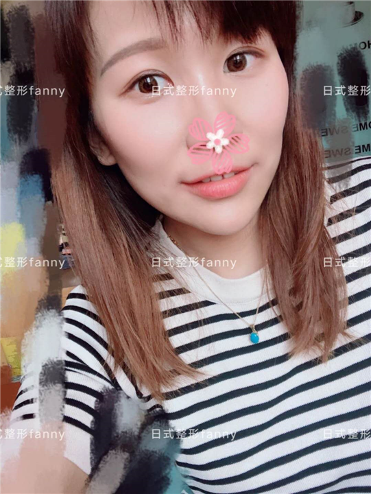 上海找日本医生做日式无痕双眼皮 