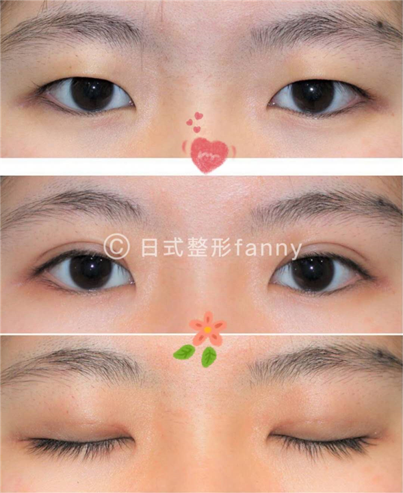 上海日式埋线无痕双眼皮 