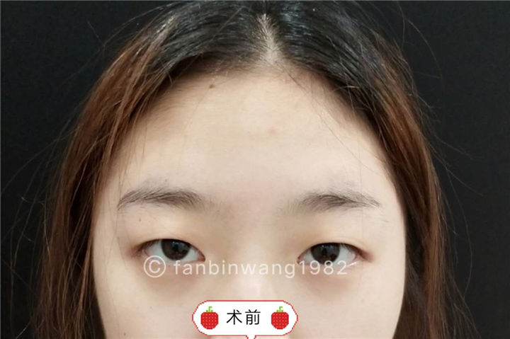 做日式无痕双眼皮术前 