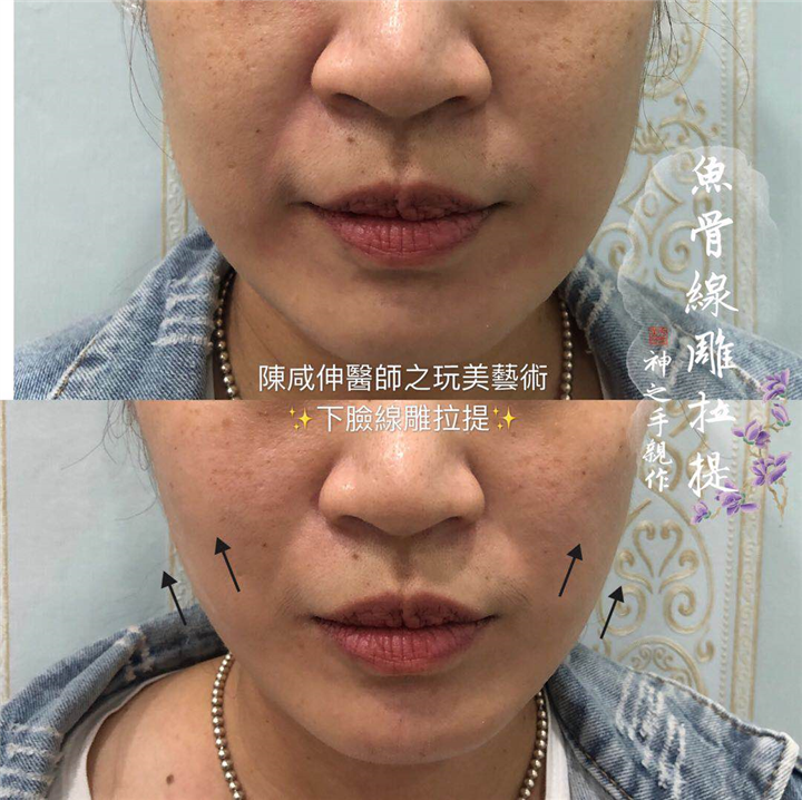 台湾鼻整形专家