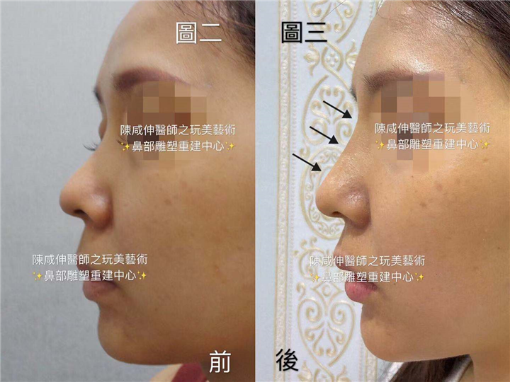 台湾线雕隆鼻 