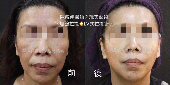 台湾鼻整形专家