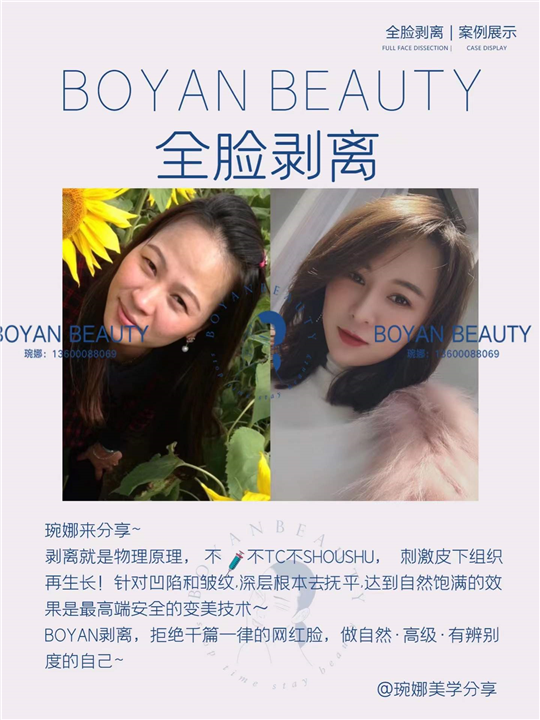 全脸剥离