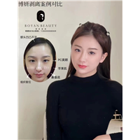 博妍剥离微雕